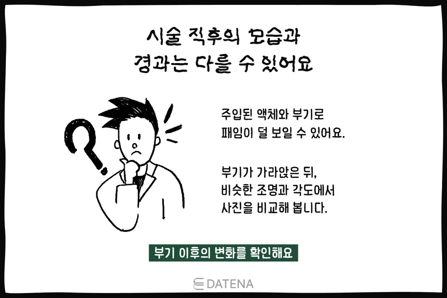 시술 직후 부기와 액체 주입으로 패임이 덜 보일 수 있음을 설명하는 인물 그림