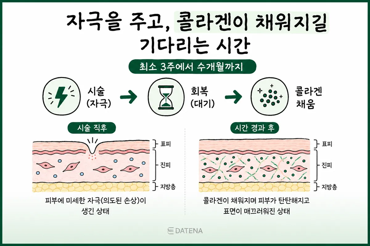 시술 직후 피부 자극에서 회복을 거쳐 콜라겐이 채워지는 과정의 피부 단면 도식