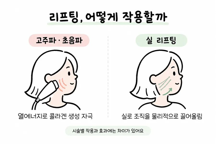고주파·초음파 리프팅과 실 리프팅의 작용 방식을 얼굴 그림으로 비교