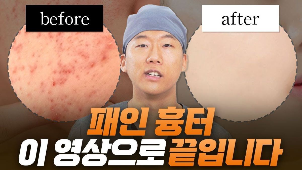 여드름흉터 치료 안내 45