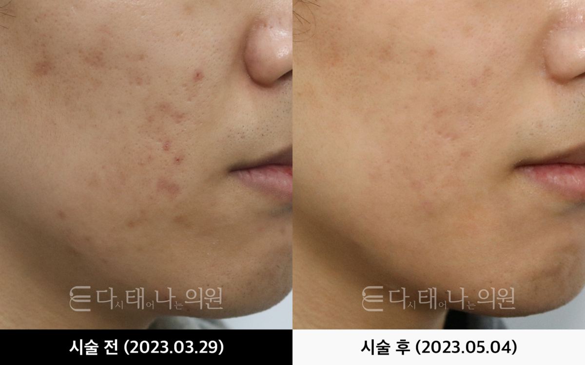 여드름흉터 치료 안내 11