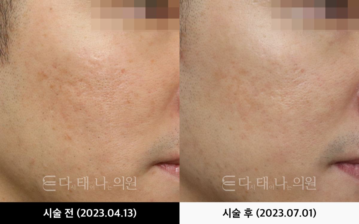 여드름흉터 치료 안내 9