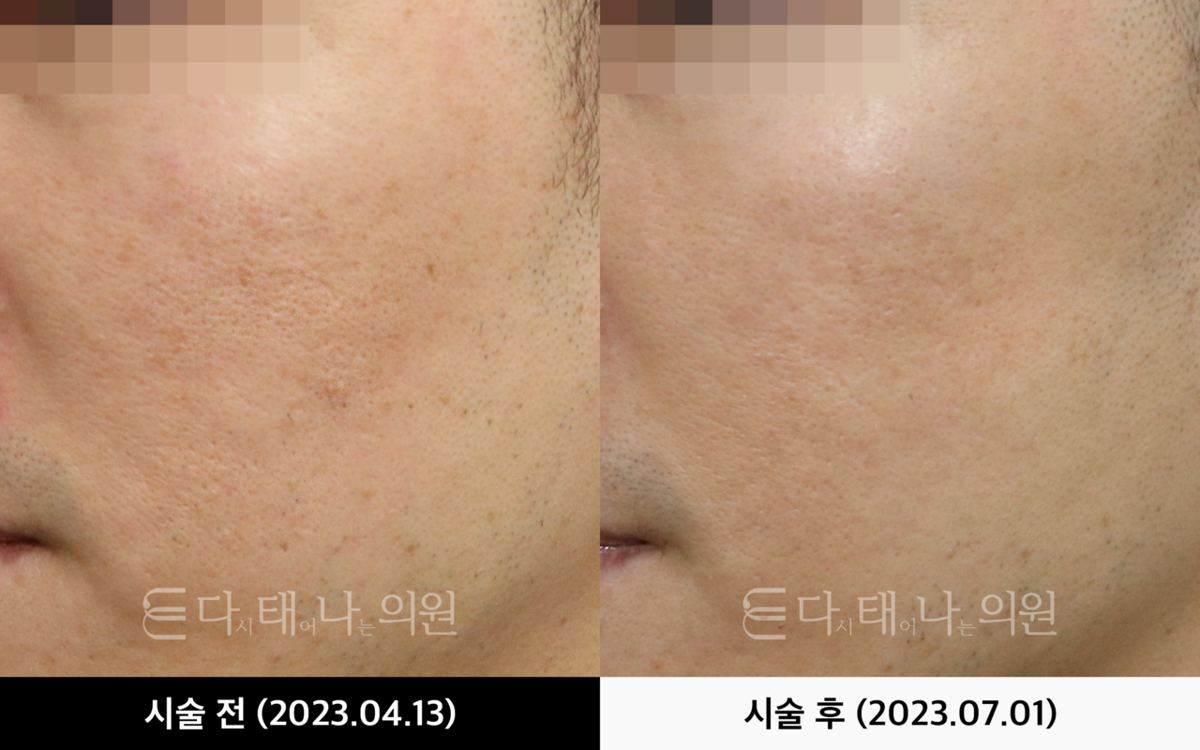 여드름흉터 치료 안내 10