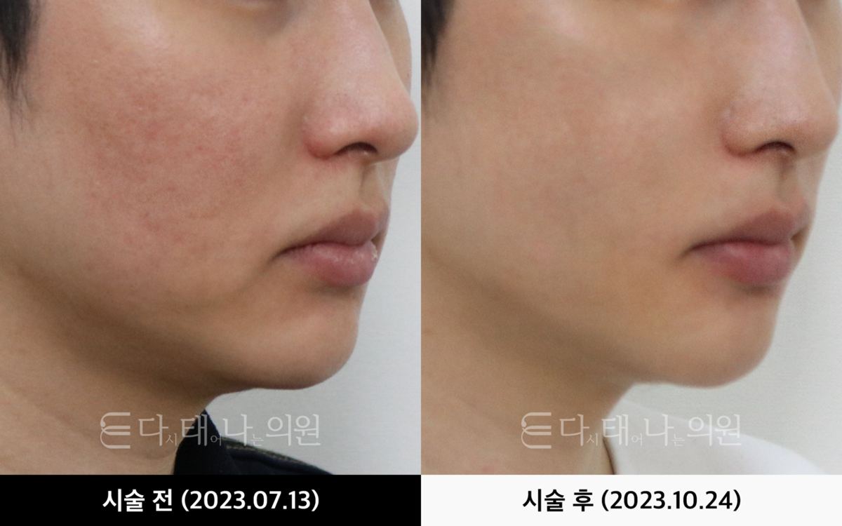 여드름흉터 치료 안내 13