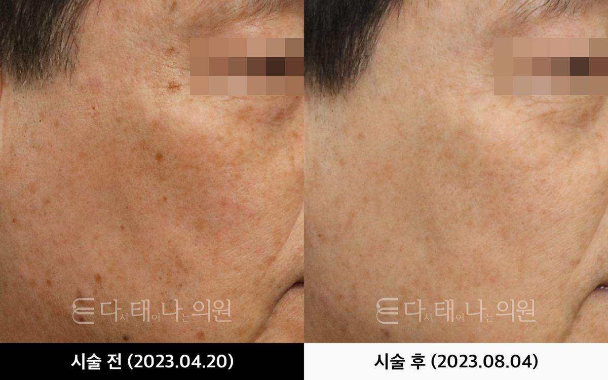 색소 레이저 안내 12