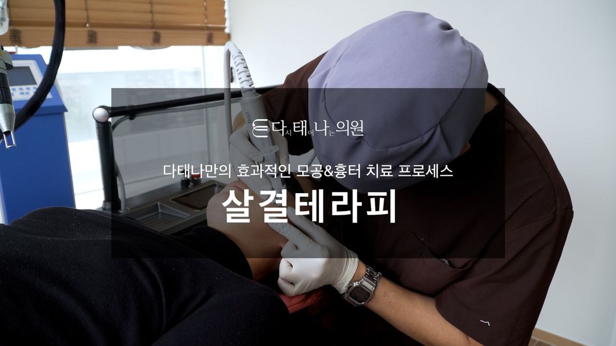 여드름흉터 치료 안내 8