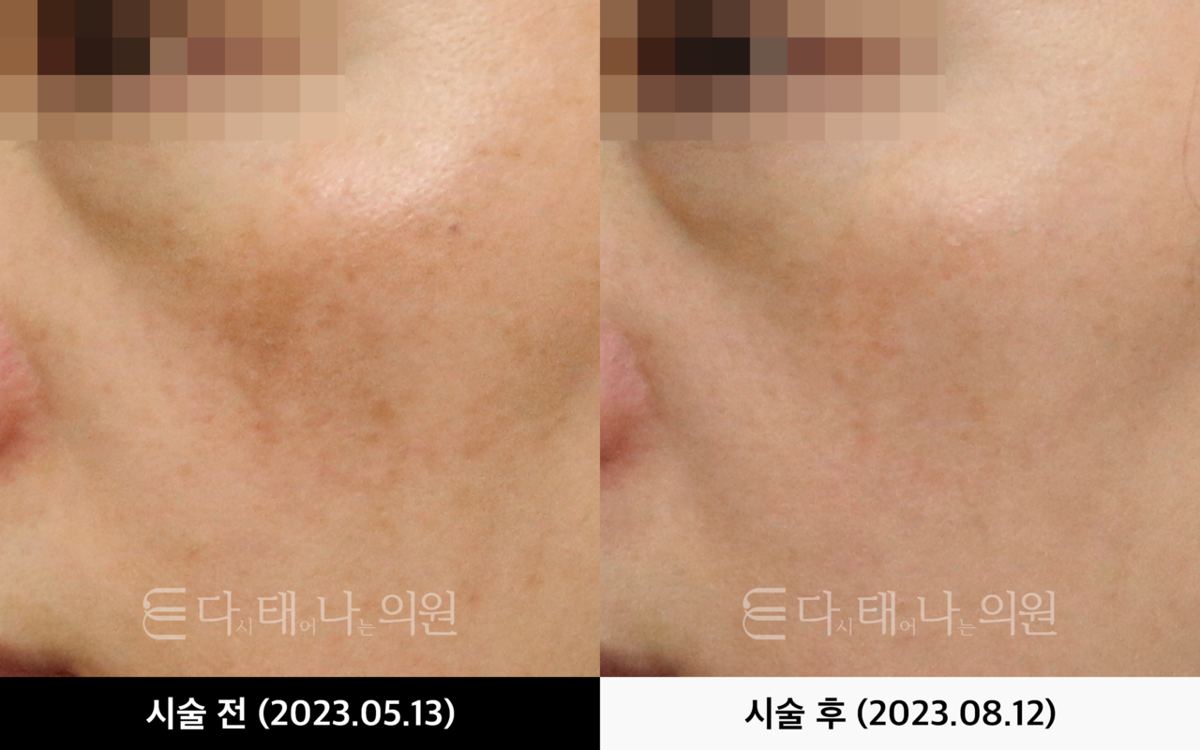 색소 레이저 안내 10