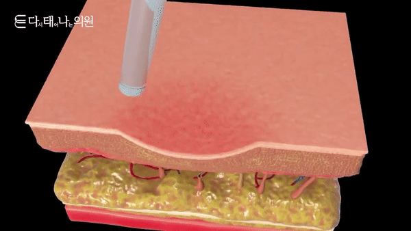 여드름흉터 치료 안내 22