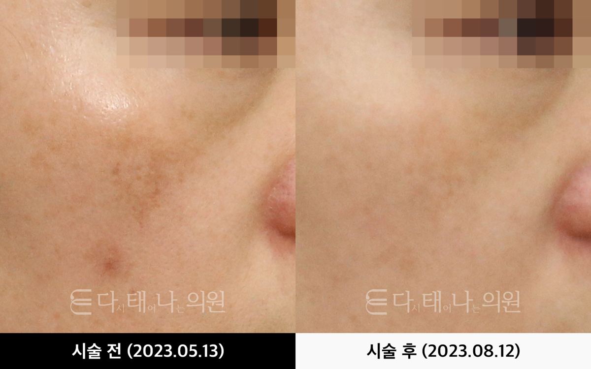 색소 레이저 안내 7